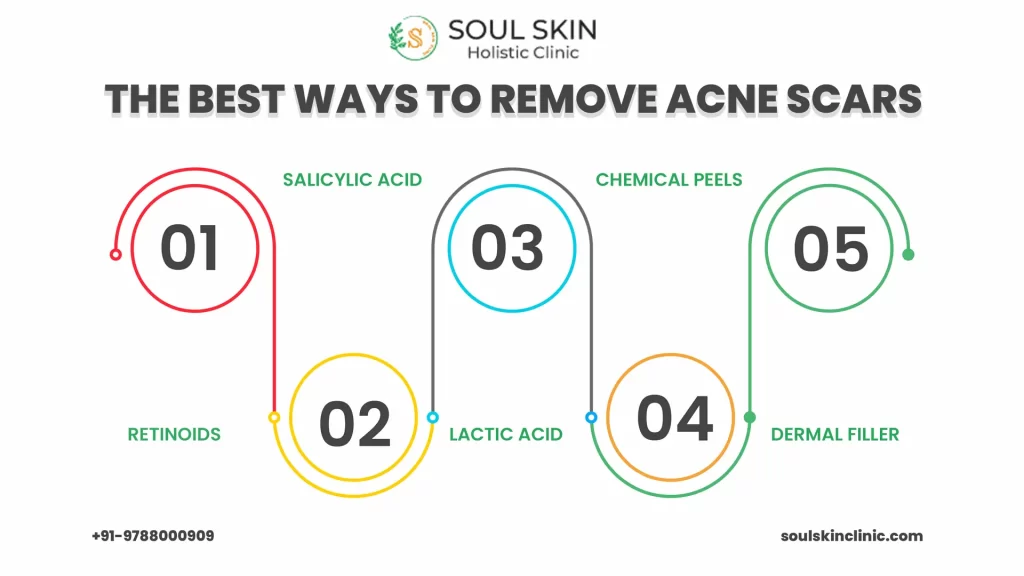 Best Acne Scar Treatment in Chennai | Soul Skin Clinic