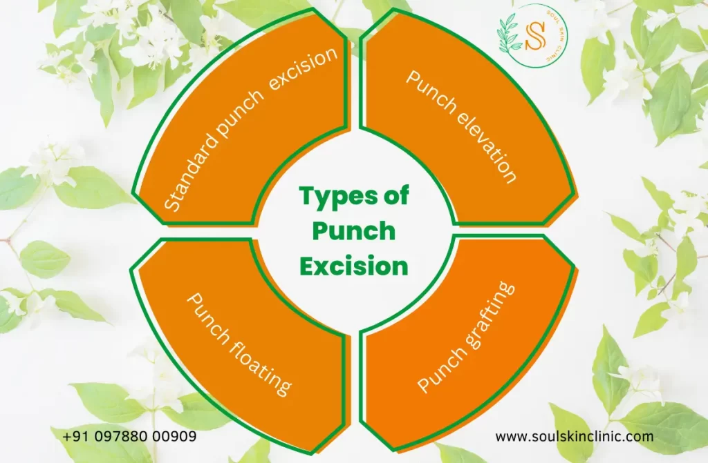Punch Excision Acne Scars Treatment in Chennai