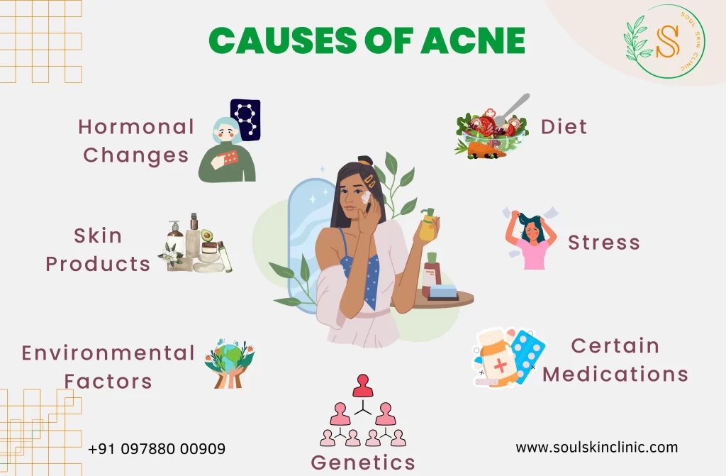 Acne Treatment in Chennai