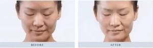 Before and after image | Soulskin Clinic