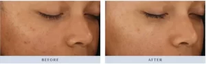 Before and after image | Soulskin Clinic
