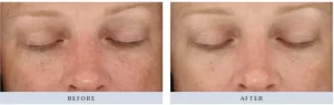 Before and after image | Soulskin Clinic | Skin care clinic in Chennai