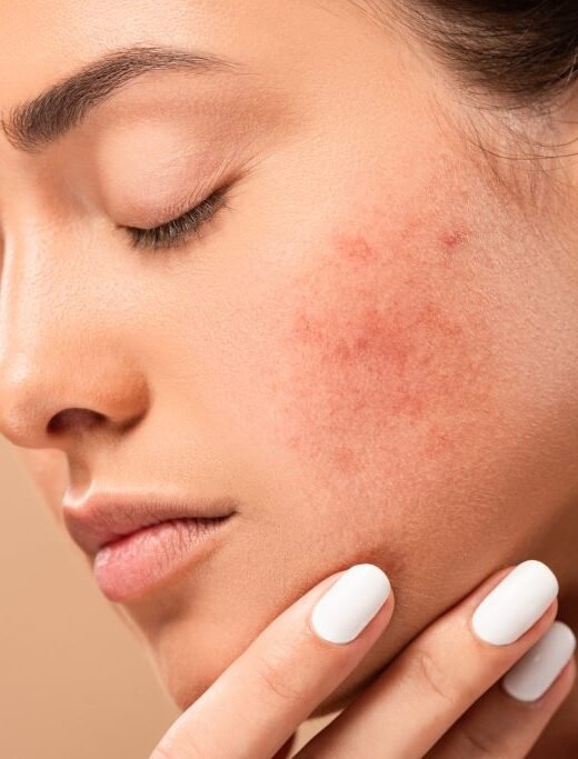 Scar Treatment in Anna Nagar – Smooth & Clear Skin