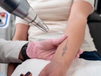 Laser Tattoo Removal Treatment in Anna Nagar | Safe & Advanced Treatment at Soul Skin Clinic
