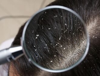 Dandruff Treatment and Oily Scalp Treatment in Anna Nagar