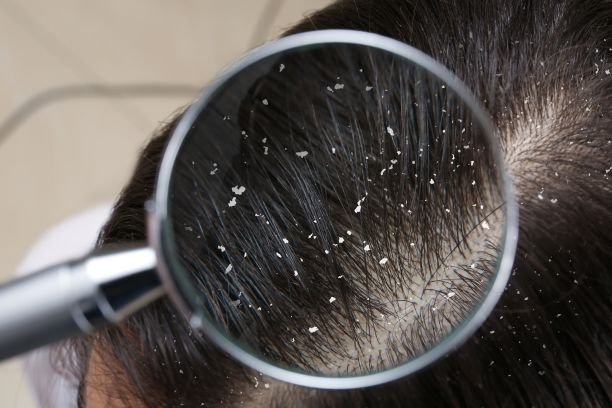 Dandruff Treatment and Oily Scalp Treatment in Anna Nagar