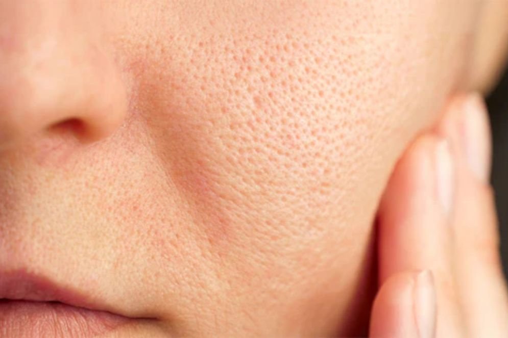 Open Pores Treatment in Anna Nagar |Soul Skin Clinic