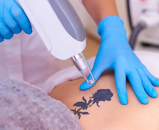 Laser Tattoo Removal - Skin Care Services