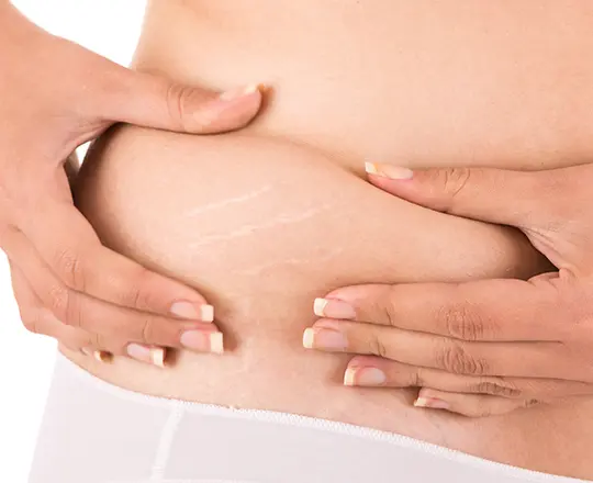 Stretch Marks - Skin Care Services