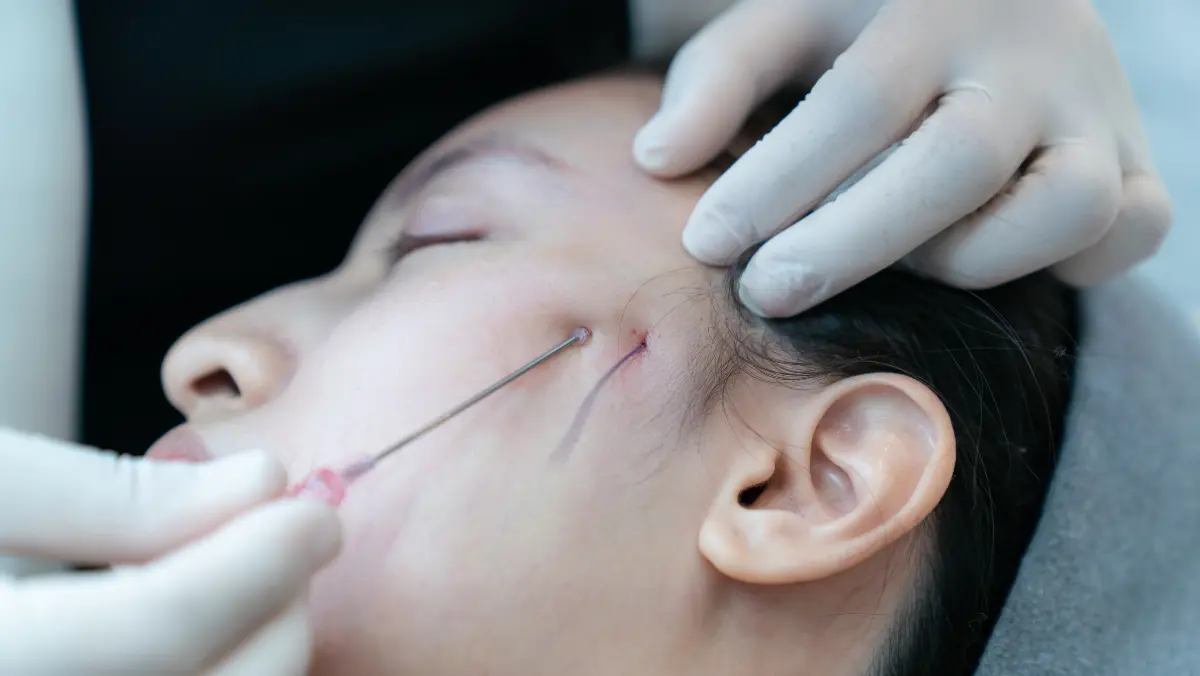 Facial Threads Lift Treatment in Chennai
