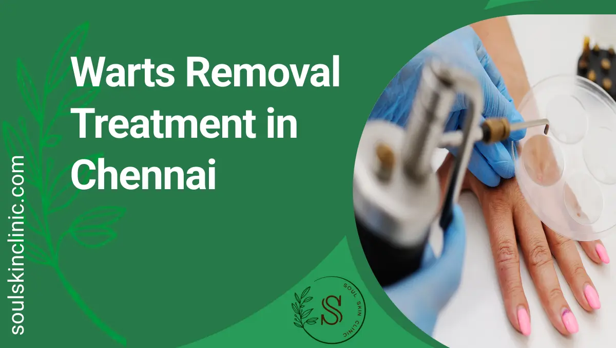 Wart Removal in Chennai