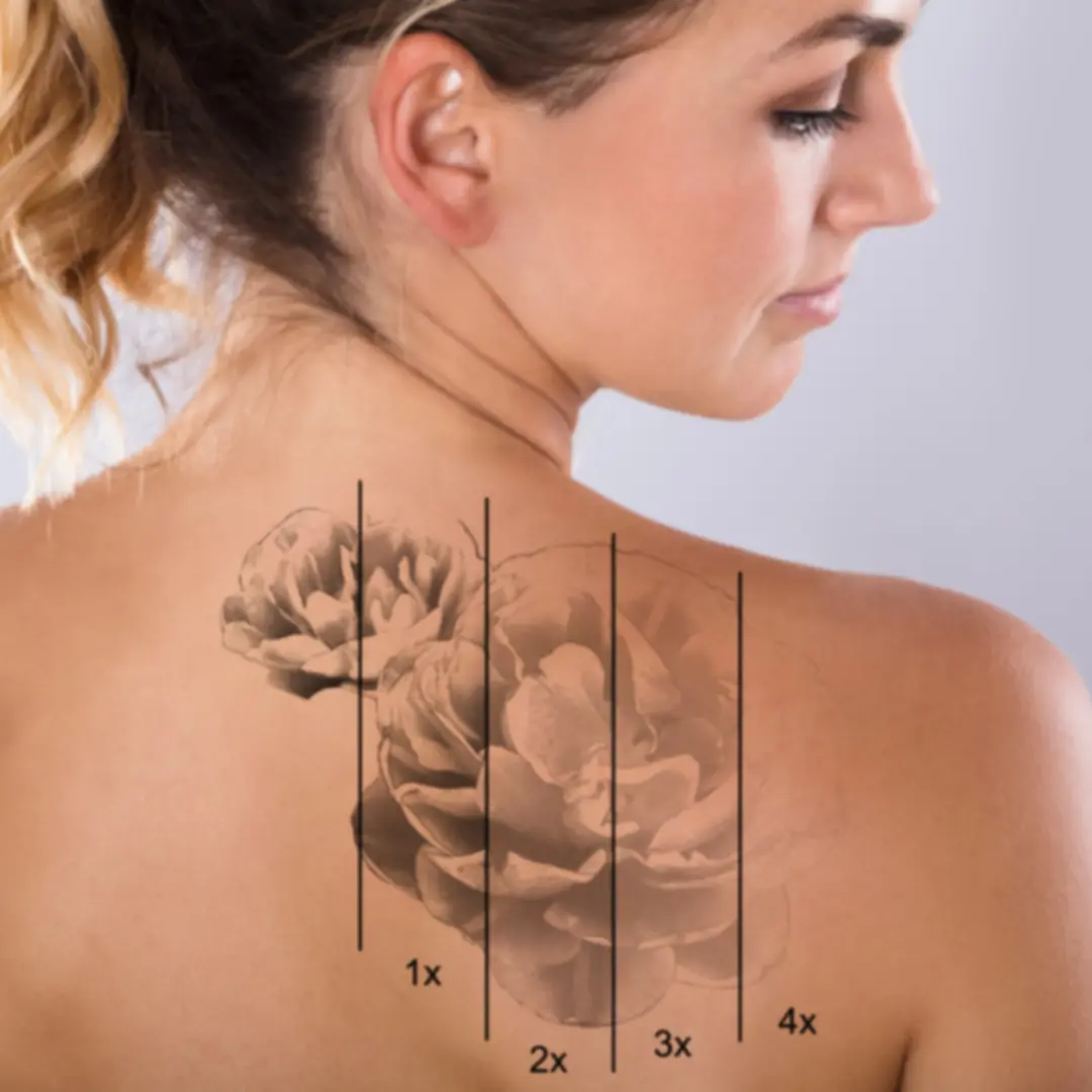 Tattoo Removal | Washington, DC | Center for Laser Surgery