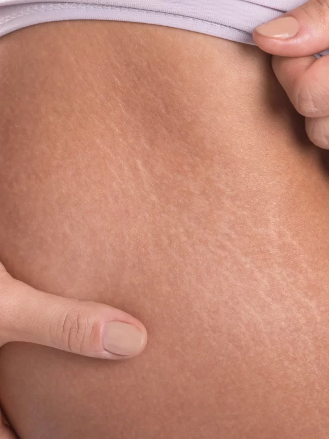 Stretch Marks Removal Treatment in Chennai