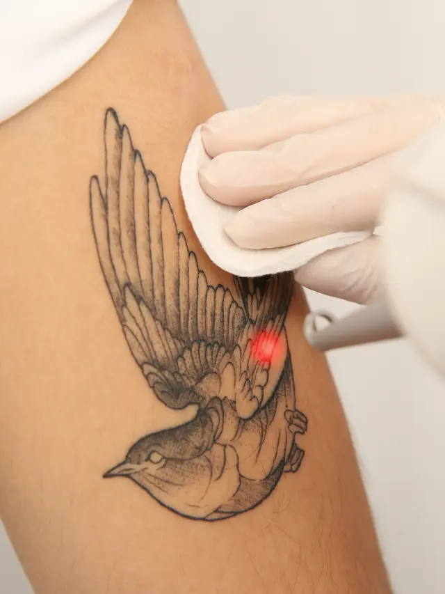 Best Laser Tattoo Removal in Chennai