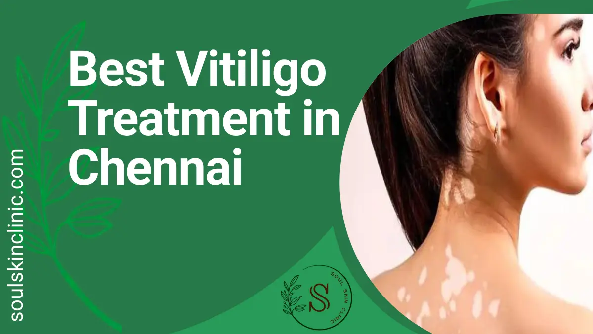 Best Vitiligo Treatment in Chennai | Soul Skin Clinic