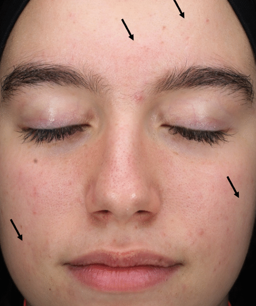 Blemiderm Acne Peel Treatment