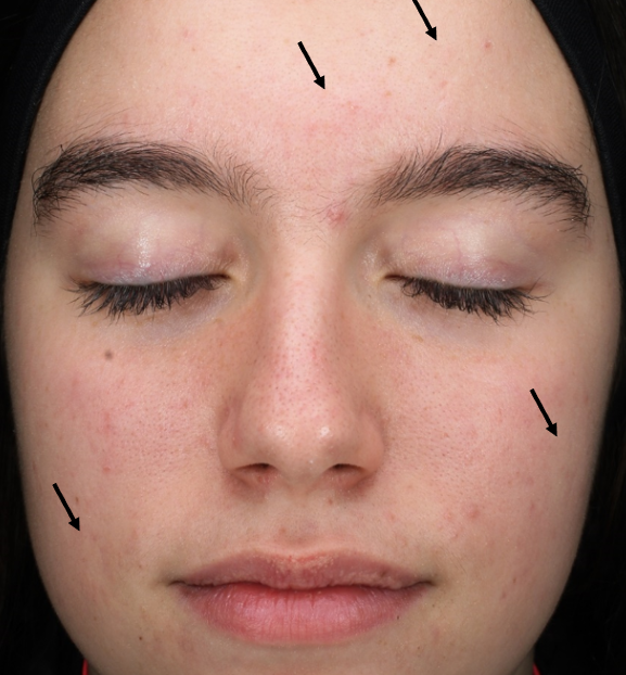 Blemiderm Acne Peel Treatment