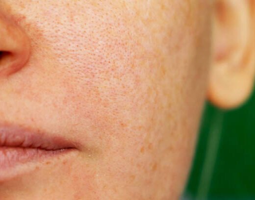 Girl with problem skin. Freckles, pigmentation, enlarged pores. Girl with problem skin. Freckles, pigmentation, enlarged pores.