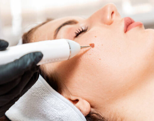 Mole, Wart & Skin Tag Removal in Anna Nagar