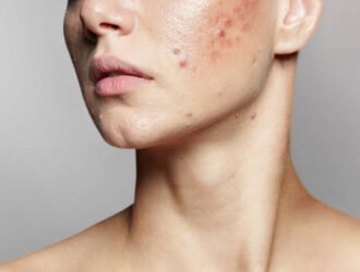 A young woman with bad skin. Skin with a lot of pimples. Acne disease, acne treatment