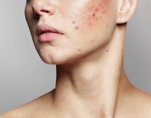 istockphoto-1352332078-612x612 A young woman with bad skin. Skin with a lot of pimples. Acne disease, acne treatment