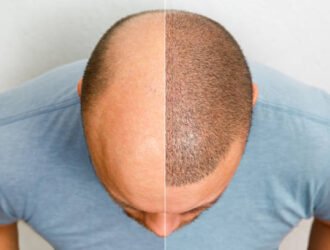 The head of a balding man before and after hair transplant surgery. A man losing his hair has become shaggy. An advertising poster for a hair transplant clinic. Treatment of baldness