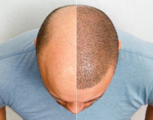 istockphoto-1359870624-612x612 The head of a balding man before and after hair transplant surgery. A man losing his hair has become shaggy. An advertising poster for a hair transplant clinic. Treatment of baldness