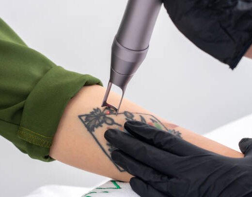 istockphoto-1377361365-612x612 Cosmetologist removing tattoo with laser device female hand. Concept of erasing tattoos as expensive procedure in cosmetology clinic