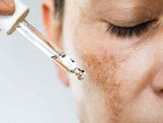 Unrecognizable female suffering from hyperpigmentation (melasma) is about to use face serum for skin brightening. 
She has dark spots on her face and  her eyes are closed.