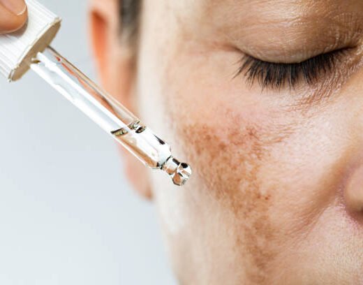 istockphoto-1456638962-612x612 Unrecognizable female suffering from hyperpigmentation (melasma) is about to use face serum for skin brightening.
She has dark spots on her face and her eyes are closed.