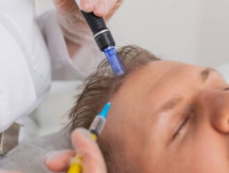 Alopecia. Man hair loss improve growth treatment regeneration, dermapen microneedling vitamin exosomes syringe injections. Trichologist cosmetologist doctor head scalp procedure fractional mesotherapy