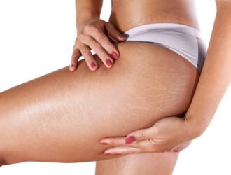 Stretch marks on woman's thighs and buttocks