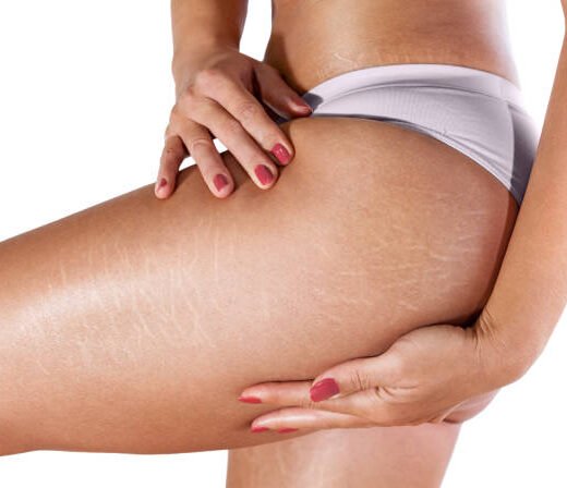 Stretch marks on woman's thighs and buttocks Stretch marks on woman's thighs and buttocks