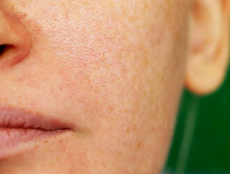 Girl with problem skin. Freckles, pigmentation, enlarged pores.