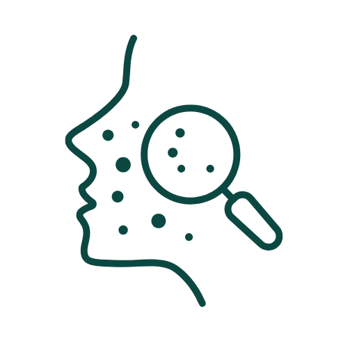 Outline of a face in profile with spots representing acne, and a magnifying glass focusing on the cheek to emphasize the need for acne scar treatment in Anna Nagar.