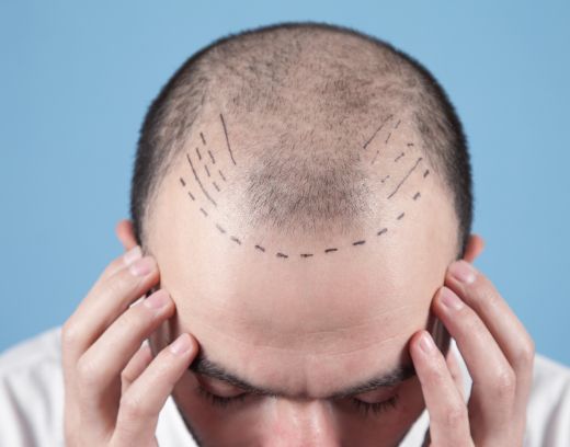 Hair Transplant Cost in Chennai: Complete Pricing Guide 2025