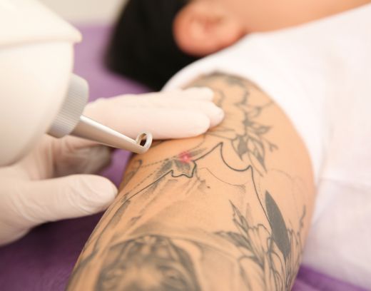 Laser Tattoo Removal in Chennai – Best Clinics & Cost