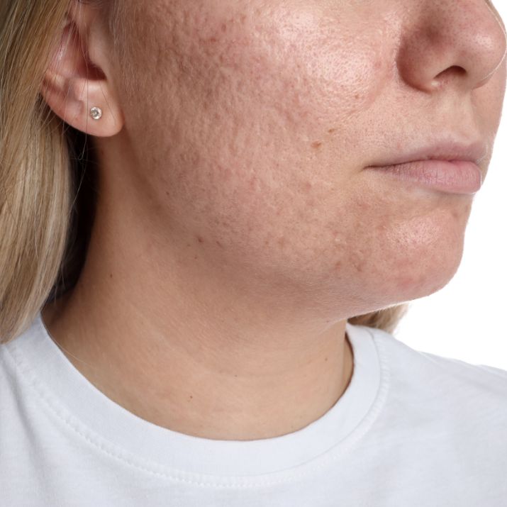 Open Pores Treatment in Chennai | Dermatologist Care | Smooth Skin Results