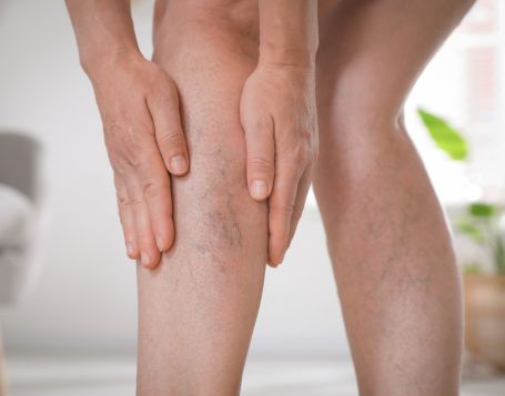 Vein Therapy in Anna Nagar | Safe Modern Vein Treatment