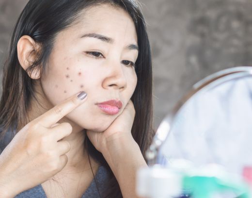 How to Remove Dark Spots Caused by Pimples | Dermatologist