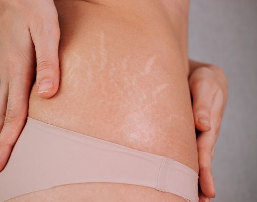 Stretch Marks Treatment in Anna Nagar