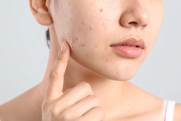 Acne Treatment in Anna Nagar