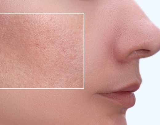 Home Remedies for Open Pores