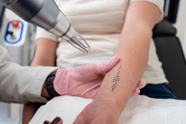 Laser Tattoo Removal Treatment in Anna Nagar | Safe & Advanced Treatment at Soul Skin Clinic