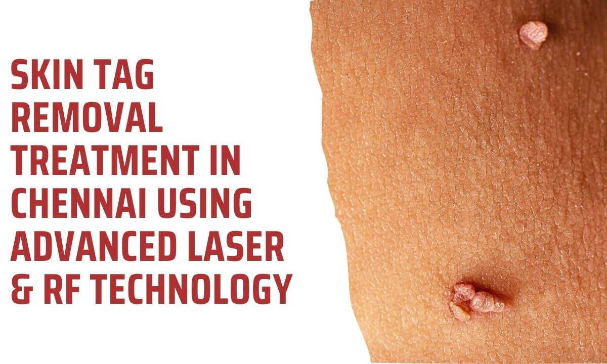 Skin Tag Removal Treatment in Chennai Using Advanced Laser & RF Technology