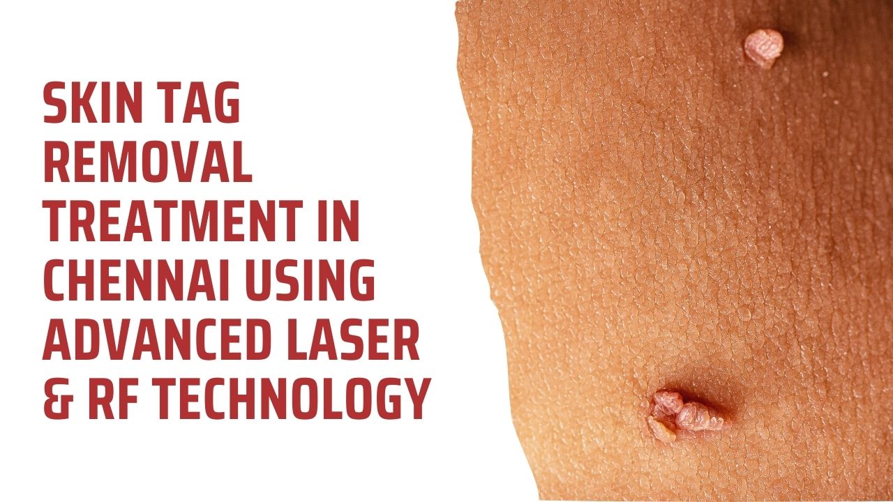 Skin Tag Removal Treatment in Chennai Using Advanced Laser & RF Technology