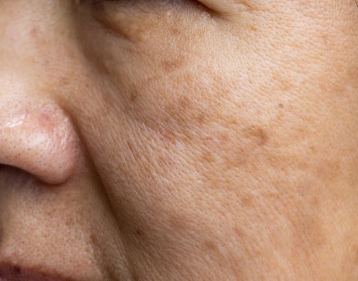 Skin Pigmentation Treatment in Chennai – Causes, Cost & Results