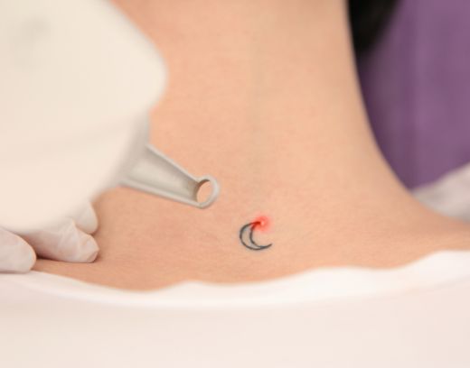 Tattoo Laser Removal Price in Chennai | Cost & Sessions