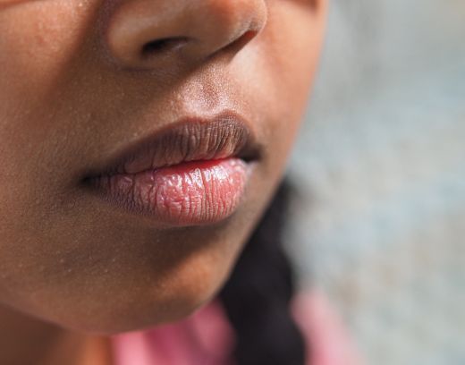 How to Avoid Dry Lips | 5 Simple Care Tips