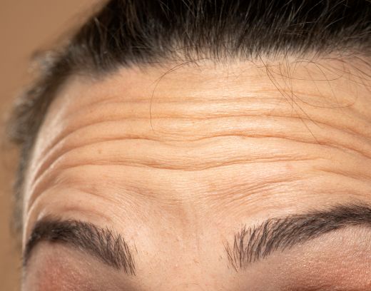 Forehead Wrinkle Remover: Treatments, Home Remedies & Prevention